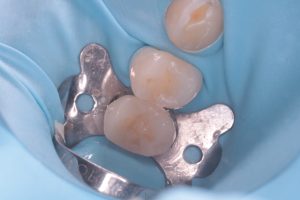 Intarsi dentali, la chiave per un sorriso perfetto grazie alla tecnologia digitale. Chiamaci allo 070721875 Intarsi dentali, la chiave per un sorriso perfetto grazie alla tecnologia digitale. Chiamaci allo 070721875