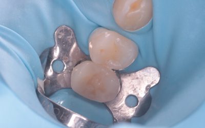 Intarsi dentali